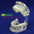 DENTAL08 (12567) Restauração de modelos de dentes de doença de implante dentário transparente